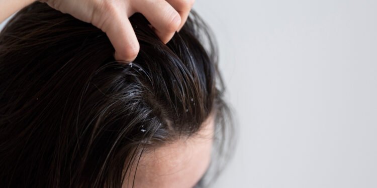 Como cuidar do cabelo oleoso sem piorar a raiz