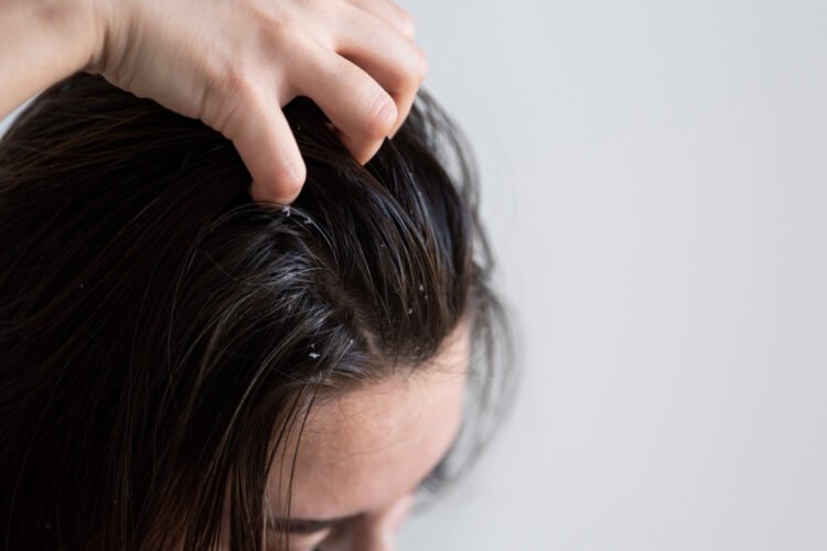Como cuidar do cabelo oleoso sem piorar a raiz